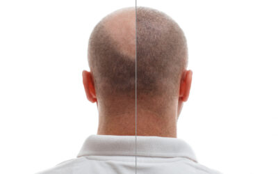 Why Hair Loss Happens and How a Hair Transplant Can Help