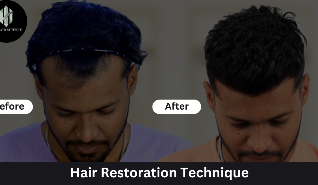 How To Know About The Most Appropriate Technique For Hair Restoration?