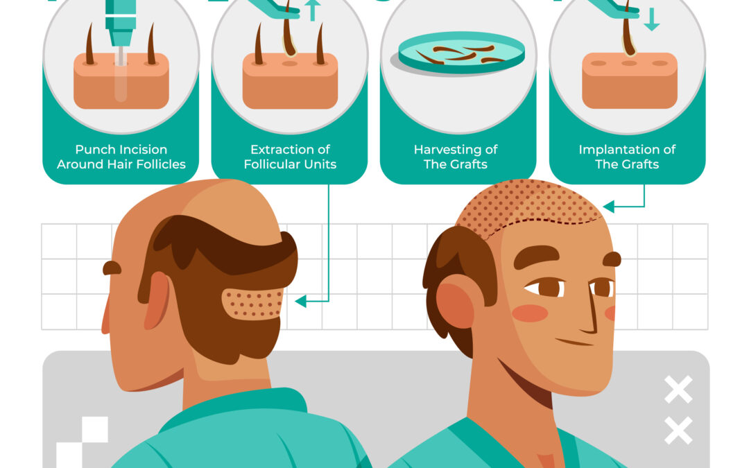 Hair Transplant for Women: Addressing Female Hair Loss Effectively
