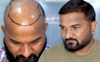 What to Expect During Your First Hair Transplant Consultation