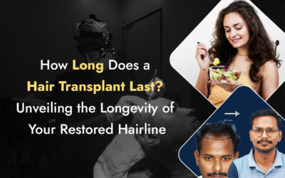 How Long Does a Hair Transplant Last?