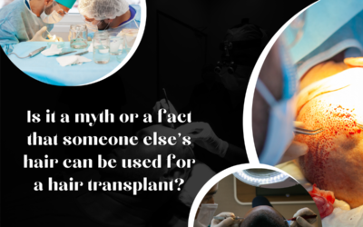 Debunking Myths: Why Using Someone Else’s Hair for Hair Transplants Is Infeasible and Unethical | IFT Hair Science Jaipur