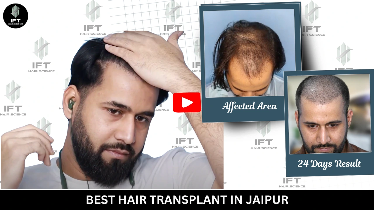 Best Hair Transplant in Jaipur