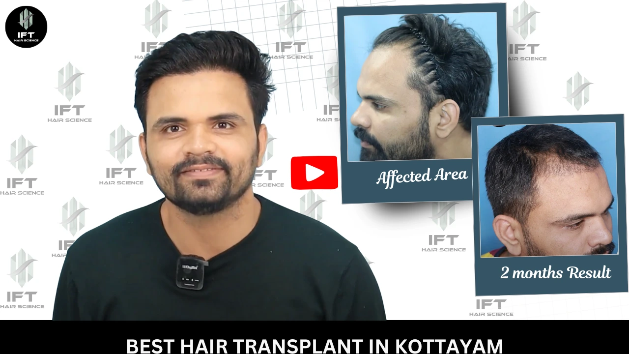 Best Hair Transplant in Kottayam