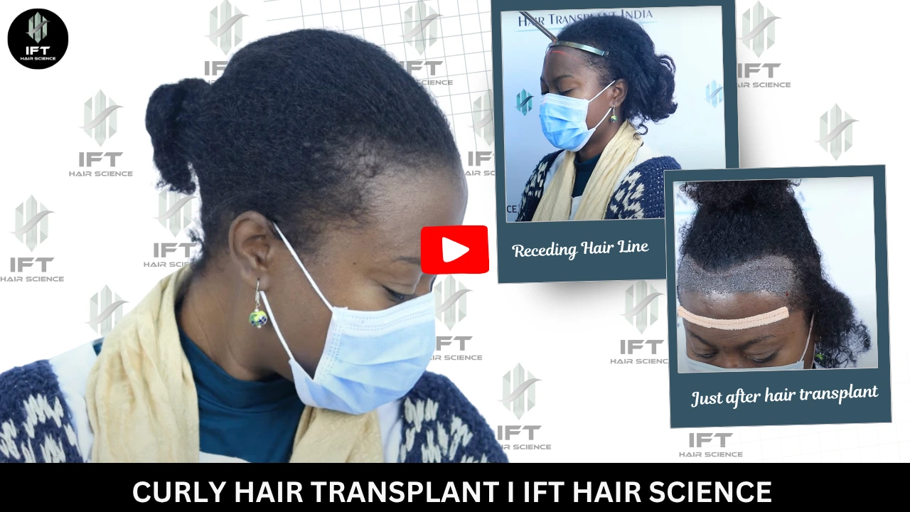 Curly Hair Transplant