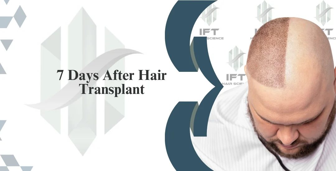7 Days After Hair Transplant: What to Expect, Do’s & Don’ts