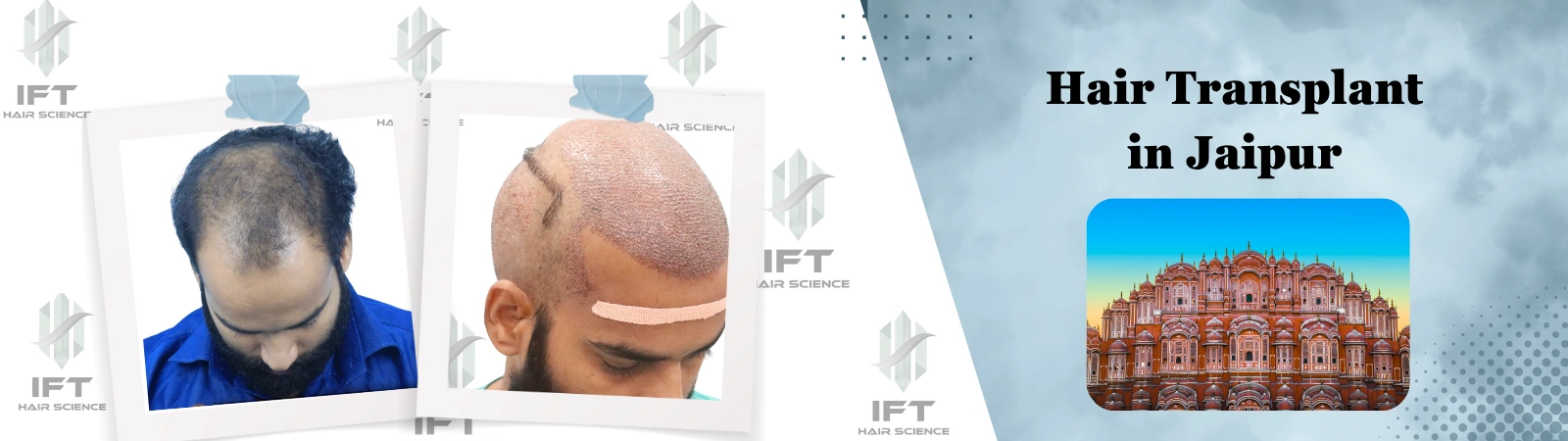 hair transplant in jaipur