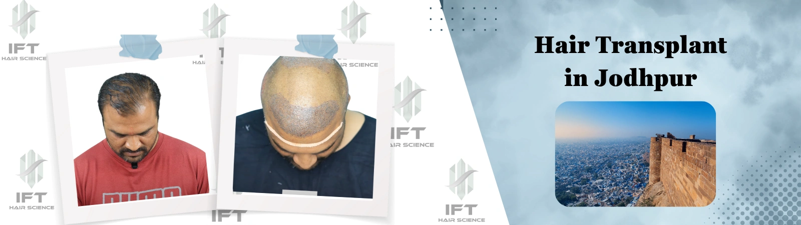 hair transplant in jodhpur