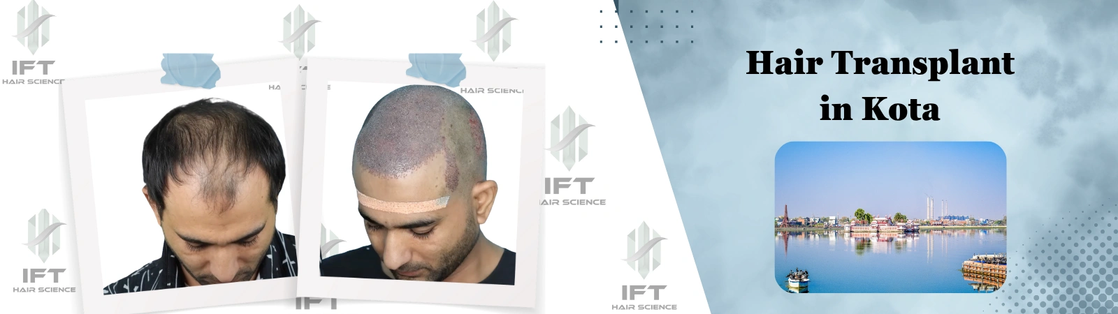 hair transplant in kota