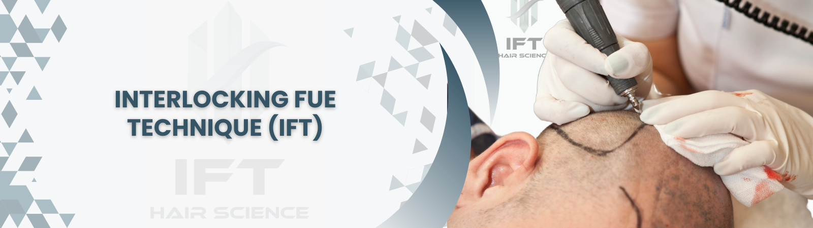 Interlocking Fue Technique with IFT Hair Science<br />
