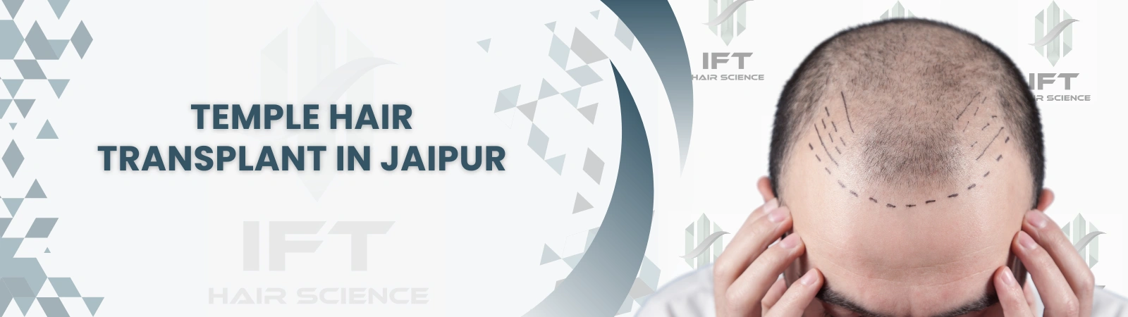 temple hair transplant in jaipur