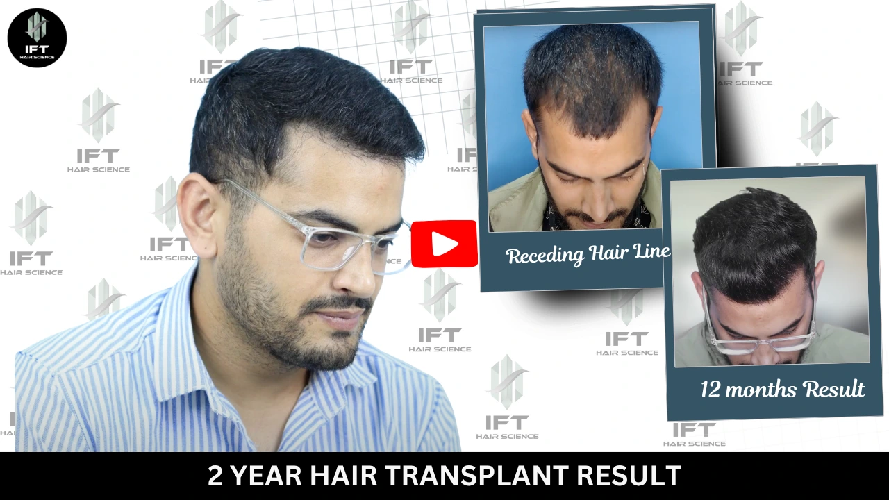 2 Years Hair Transplant Result