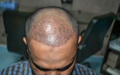 Sleep Position After Hair Transplant
