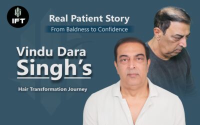 Real Patient Story: From Baldness to Confidence – Vindu Dara Singh’s Hair Transformation Journey