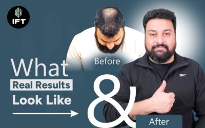 Before & After: What Real Results Look Like in Modern Hair Restoration
