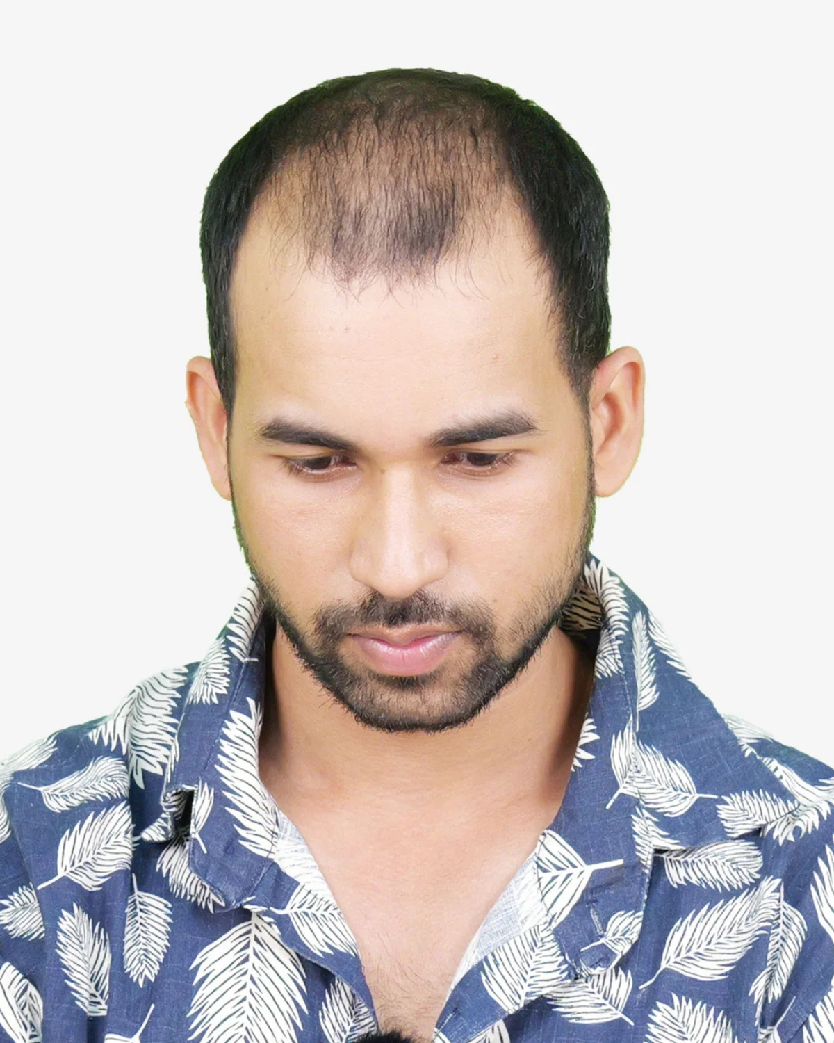 Hair Transplant Before