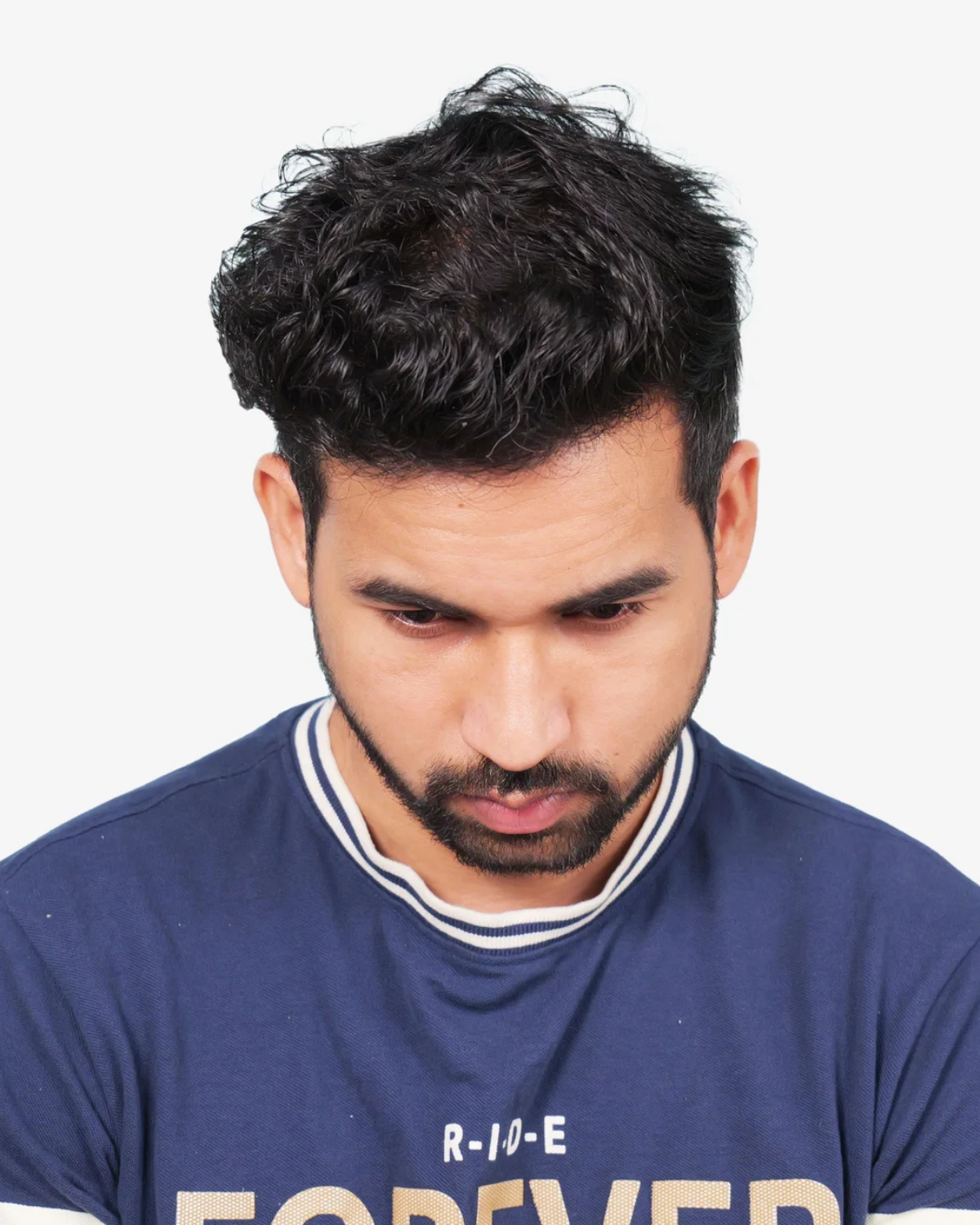 Hair Transplant After